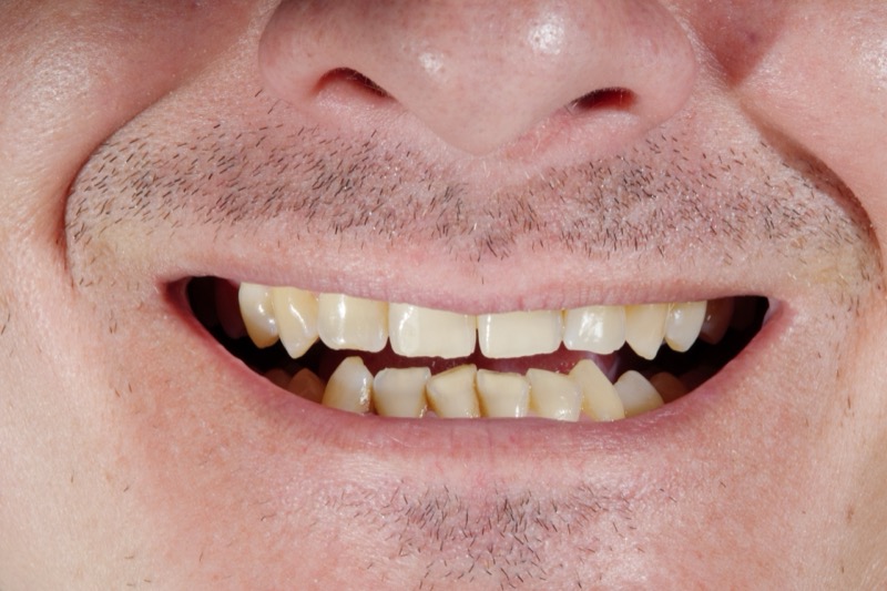 Sorriso antes das facetas dentárias