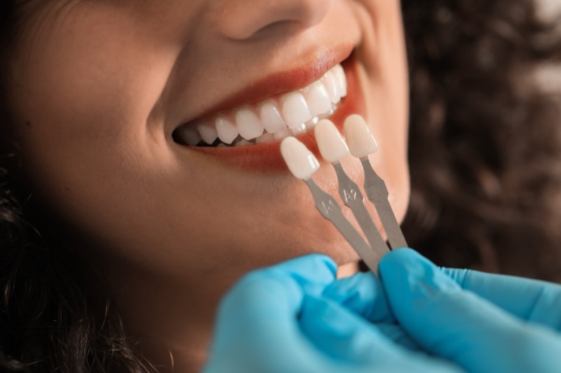 Resultado de facetas dentárias — caso 1