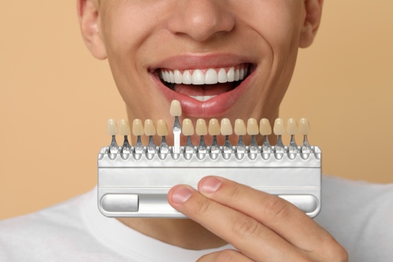 Resultado de facetas dentárias — caso 2