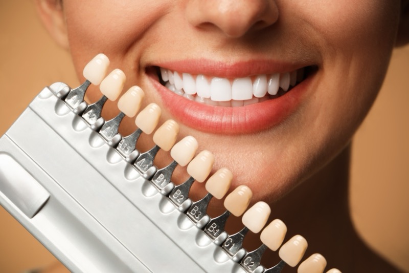 Resultado de facetas dentárias — caso 3