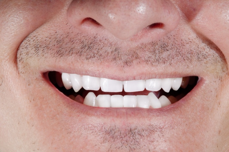Sorriso depois das facetas dentárias